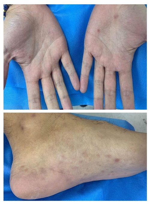Exantema maculopapular en palmas y plantas