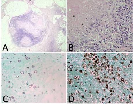Biopsia de ganglio linf&aacute;tico izquierdo. A. Se observa ganglio linf&aacute;tico con numerosos granulomas de diferentes tama&ntilde;os, algunos con extensa necrosis central rodeada por histiocitos y algunas c&eacute;lulas gigantes multinucleadas; en el material necr&oacute;tico se aprecian estructuras redondeadas rosadas. B. Se observan levaduras esf&eacute;ricas de doble pared, de 30 a 60 μm de di&aacute;metro. Hematoxilina y eosina, 20X. C y D. Se aprecian numerosas estructuras mic&oacute;ticas redondas, alguna en "tim&oacute;n de barco". Gomori, 20X.