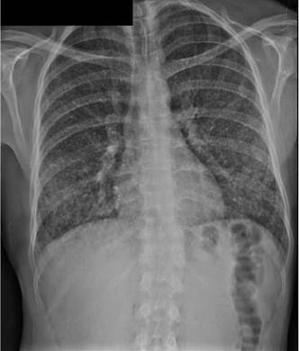 Radiograf&iacute;a de t&oacute;rax del paciente del segundo caso. Se reportan infiltrados miliares difusos.