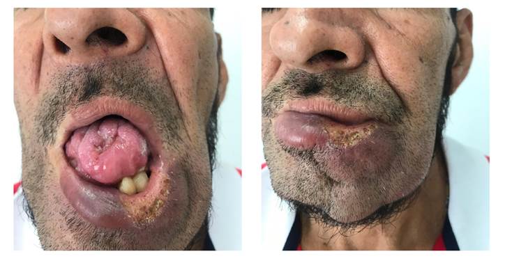 Se aprecia la lesi&oacute;n de la lengua, la mucosa oral y los labios, en forma de placa viol&aacute;cea infiltrada con &uacute;lcera central granulomatosa, con compromiso de la mucosa oral y el ment&oacute;n; cambios fibrocicatriciales en la lengua y las enc&iacute;as, y p&eacute;rdida de numerosas piezas dentales y cerca de la mitad del cuerpo lingual.