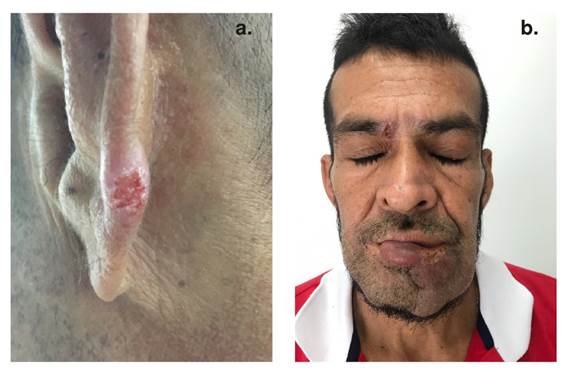 a. Lesi&oacute;n en la h&eacute;lice izquierda: placa viol&aacute;cea ulcerada. b. Foto panor&aacute;mica en la que se puede observar el compromiso de las lesiones en labio inferior y ceja derecha.