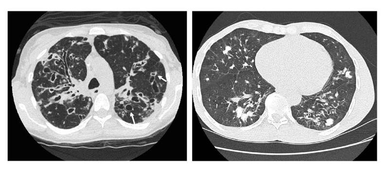 Tomograf&iacute;a computarizada de alta resoluci&oacute;n de t&oacute;rax (TACAR). Las flechas de la imagen izquierda indican m&uacute;ltiples granulomas calcificados distribuidos en todos los segmentos y los l&oacute;bulos pulmonares con predominio en las bases y la regi&oacute;n parahiliar.