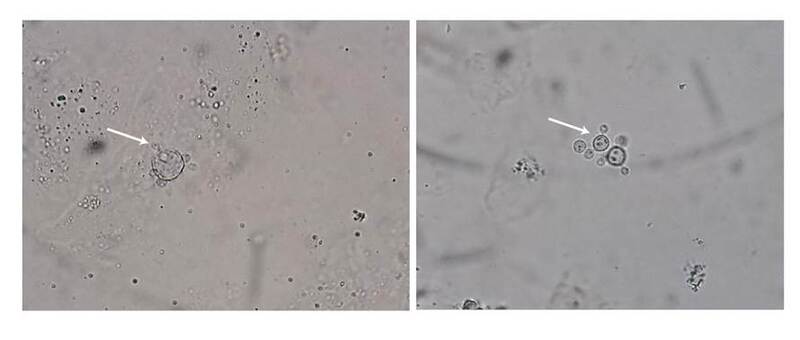 Examen directo de las muestras de raspado de la lesi&oacute;n de la lengua, la mucosa oral, el labio, la ceja y la h&eacute;lice izquierda, tratadas con soluci&oacute;n del 10 % de hidr&oacute;xido de potasio (KOH) y 0,2 % de azul de Evans. Se observan blastoconidias multigemantes de pared gruesa con inclusiones intracitosplasm&aacute;ticas.