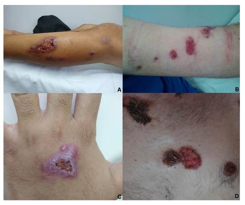 A y B. Lesión en miembro inferior izquierdo y en antebrazo izquierdo de esporotricosis linfangítica nodular. C. Lesión en mano de esporotricosis cutánea fija. D. Lesiones en tronco de esporotricosis diseminada.