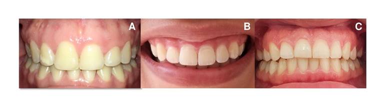 Initial photos. The clinical characteristics of the periodontium of each patient are observed.