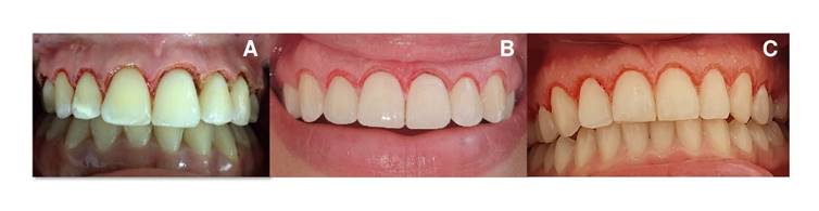 Images after the gingivectomy. A. Electric scalpel. B. 940 nm diode laser. C. 2780 nm Er,Cr:YSGG laser.