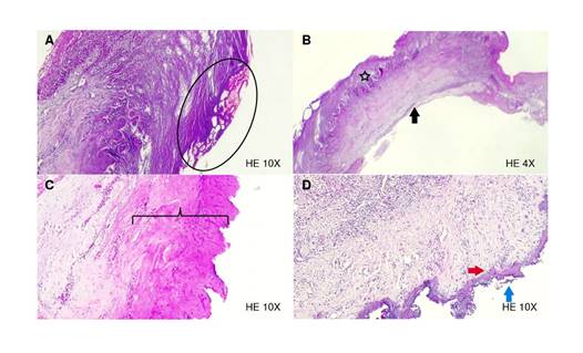 Histological sections. A) Electric scalpel: ovals indicate extensive burn changes. B) Electric scalpel: intercellular edema (star), and the deep resection margin shows a clear border (black arrow) with no evidence of carbonization. C) 940 nm diode laser: basophilic changes due to collagen degeneration (square brackets). D) 2780 nm Er,Cr:YSGG laser: fine homogeneous basophilic band (red arrowhead) and signs of carbonization with sloughing (blue arrow) of the tissue.