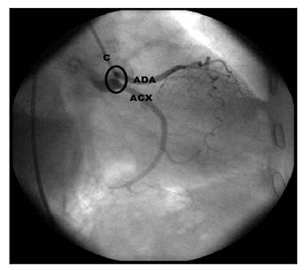 Imagen angiogr&aacute;fica con cateterismo. En el seno a&oacute;rtico izquierdo no hay arteria coronaria izquierda y se identifican dos orificios independientes para dar origen a la arteria interventricular anterior y a la circunfleja izquierda.