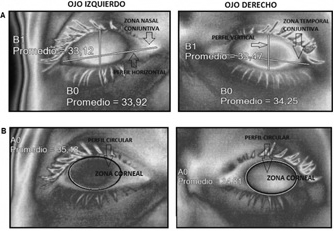 A.- Perfiles t&eacute;rmicos
vertical y horizontal ubicados en la superficie ocular mediante el software
SMARTVIEW. B.- Marcadores circulares ubicados en la regi&oacute;n c&oacute;rneal mediante el
software Smartview. (valores numerocos en &deg;C).