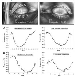  Perfiles de
temperatura promedio, utilizando los valores medios de temperatura para el ojo
derecho e izquierdo del sujeto escogido - Secci&oacute;n 1.