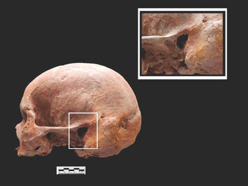 Osteolisis en canal auditivo del individuo del Conjunto 922 Monitoreo Fase II Bloque C8-I Nivel IV profundidad 184 cm, Cráneo 20