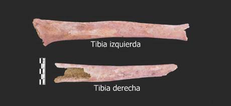 Periostosis en tibias del individuo del Conjunto 002 Monitoreo Fase I Bloque B6-I Nivel 1? profundidad 198 cm, Individuo cráneo 17