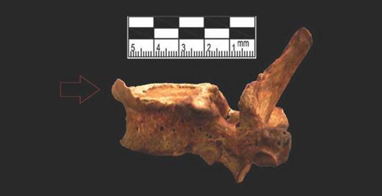 Osteofito en vértebra torácica del individuo del Conjunto 005 Monitoreo Fase I Bloque A6-II, Individuo 7