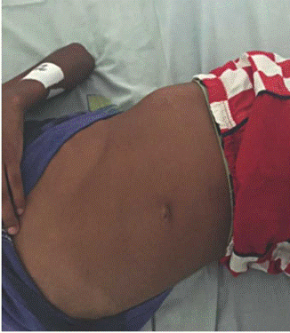 Hepatomegalia con onda asc&iacute;tica