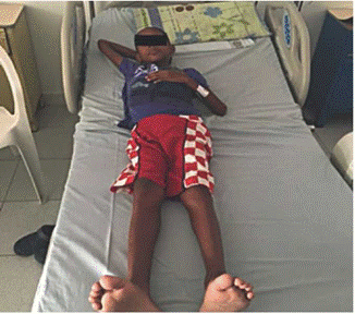 Paciente con s&iacute;ndrome Mauriac con hipo-trofia generalizada