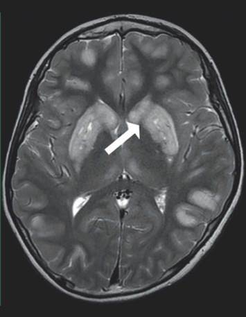 Imagen de RMC representativa del paciente 5. Imagen de resonancia magnética cerebral simple con corte axial con evidencia de lesiones hiperintensas a nivel de ganglios basales bilateral de forma simétrica.