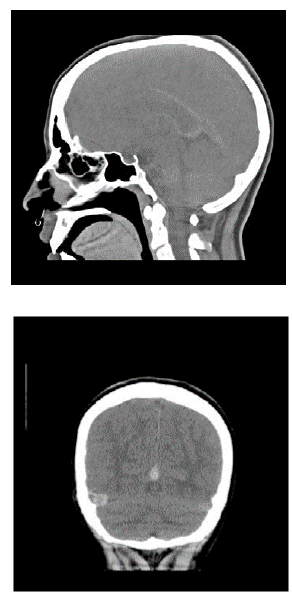 Tomograf&iacute;a axial computarizada (TAC) de cr&aacute;neo simple.