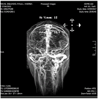 Angioresonancia cerebral contrastada