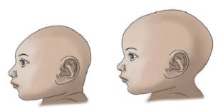Ilustraci&oacute;n de malformaci&oacute;n f&iacute;sica producida por la microcefalia. 