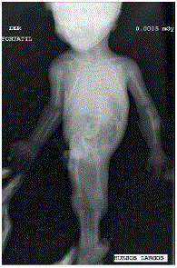 Radiografía de huesos largos que muestra fusión de tejidos blandos en miembros inferiores.