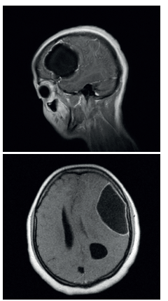 RMN contrastada en proyecci&oacute;n sagital y axial, donde se observan lesiones que sugieren neurocisticercosis racemosa.