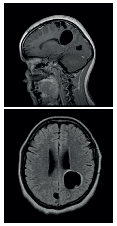 RMN contrastada proyecci&oacute;n sagital y axial, donde se evidencia progresi&oacute;n de las lesiones qu&iacute;sticas m&uacute;ltiples y resoluci&oacute;n de quiste frontoparietal izquierdo.