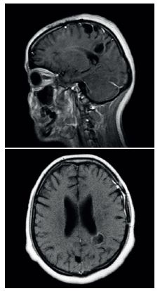 RMN contrastada proyecci&oacute;n sagital y axial, donde se evidencia reducci&oacute;n del tama&ntilde;o de las lesiones qu&iacute;sticas m&uacute;ltiples.