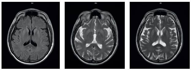 RMN cerebral y con contraste T2. Hiperintensidad en regi&oacute;n anterior e inferior n&uacute;cleo-basal bilateral sim&eacute;trica.