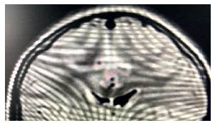 RNM cortes coronales y axiales con hiperintensidad en FLAIR en hipocampo bilateral con predominio derecho.