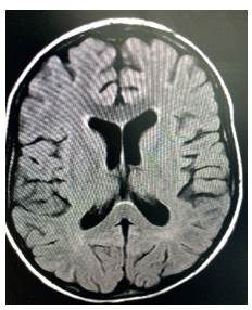 RNM cerebral en corte axial con evidencia de acentuaci&oacute;n de surcos corticales mayores que los esperado para la edad.