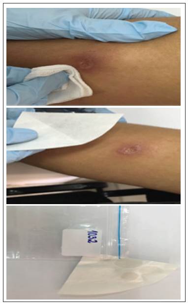 Protocolo adaptado de Boggild et al. 201015por el LRI DISAN para la toma de impronta de lesión de Leishmania. A. Limpieza y desinfección. B. Eliminación de la costra. C. Toma de la impronta. D. Secado al aire libre para su almacenamiento.