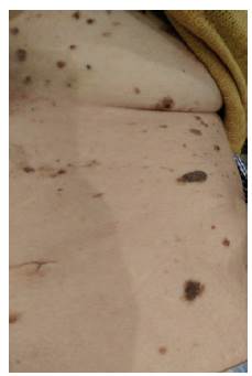 M&iacute;ltiples queratosis seborreica en abdomen y torax.