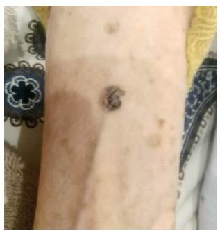 Queratosis seborreica de 1 x 1 cm en cara anterior tercioproximal de antebrazo.