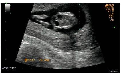 Embarazo de 12,1 semanas, signo de doble burbuja intraabdominal, compatible con atresia duodenal.