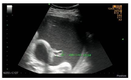 Embarazo de 31,5 semanas, arteria umbilical &uacute;nica.