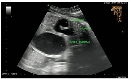 Embarazo de 31,5 semanas, signo de doble burbuja intraabdominal, dilataci&oacute;n esof&aacute;gica en el tercio distal; corte longitudinal.
