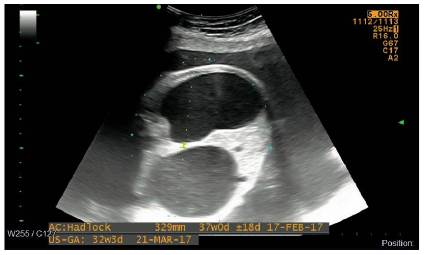 Embarazo de 31,5 semanas, signo de doble burbuja intraabdominal, corte transversal abdominal.