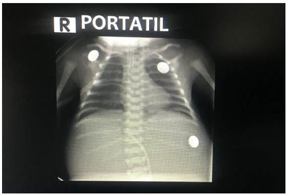 Rx de t&oacute;rax del reci&eacute;n nacido: presencia de arcos costales derechos fusionados, hemiv&eacute;rtebras y ausencia de gas en c&aacute;mara g&aacute;strica considerando una atresia esof&aacute;gica tipo 1.