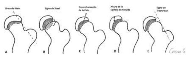Hallazgos Radiológicos en EFP.