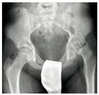 Radiografía A-P de pelvis con el porcentaje de desplazamiento de la epífisis sobre la anchura de la metáfisis.