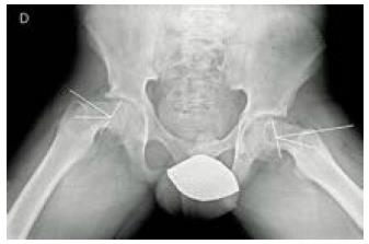 Radiografía axial de ambas caderas. Epifisiólisis de 36 ◦ en cadera derecha y 27 ◦ en cadera izquierda.