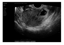 Emabarazo localizado en istmo uterino vs. cicatriz uterina. 