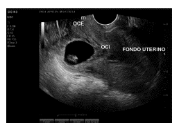 &Uacute;tero en RVF con cavidad endometrial vac&iacute;a. 