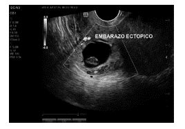 Vascularizaci&oacute;n: Se observa saco gestacional con presencia de Doppler color positivo a su alrededor, y polo embrionario de 12.2mm a su alrededor. 