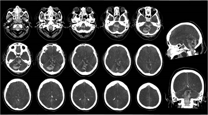 Tomografía de cráneo simple de caso clínico 1, con evidencia de hematoma retrovermiano que se extiende al hemisferio cerebeloso derecho, asociado a hemorragia subaracnoidea en el sistema supra e infratentorial con extensión a la fisura interhemisférica y en los valles silvianos, edema generalizado con obliteración del espacio aracnoideo de la convexidad y de todas las cisternas de la base.