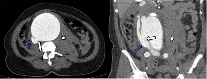 Angiotac de abdomen cortes axial y coronal. Opacificaci&oacute;n de estructura venosa (VCI) durante la fase arterial del estudio con comunicaci&oacute;n de la luz de la aorta abdominal y la vena cava inferior (flecha blanca) asociado a cambios inflamatorios peria&oacute;rticos y hematoma (asterisco).