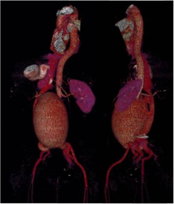 Reconstrucci&oacute;n 3D. Dilataci&oacute;n aneurism&aacute;tica de la aorta abdominal infrarrenal que se extiende a la bifurcaci&oacute;n il&iacute;aca; se encuentra en estrecho contacto con la vena cava inferior y desplaz&aacute;ndola a la derecha.