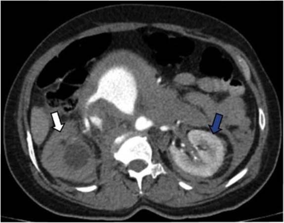 AngioTC de abdomen corte axial. Se observa ausencia de realce del par&eacute;nquima renal derecho por hipoperfusi&oacute;n (flecha blanca) comparado con el ri&ntilde;&oacute;n izquierdo (flecha azul).