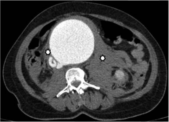 Angiotac de abdomen en corte axial. Estriaci&oacute;n de la grasa peria&oacute;rtica y hematoma retroperitoneal (asteriscos). Opacificaci&oacute;n de la VCI y ulcera aterioescler&oacute;tica penetrante (flecha blanca).