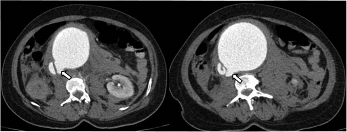 AngioTC de abdomen en cortes axiales. &Uacute;lceras arterioescler&oacute;ticas penetrantes (flechas blancas) en la cara posteriory lateral derecha de la aorta abdominal en diferentes niveles.